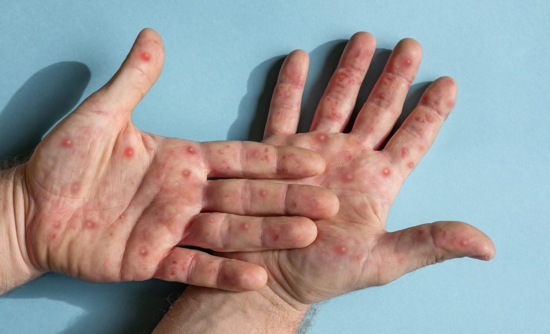 The Most Effective Ways To Prevent The Spread Of Monkeypox